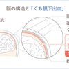 くも膜下出血に関する雑学