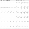 ECG-113：90才男性。突然の心窩部痛で深夜ER搬入。