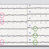 ECG-119：answer