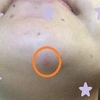 鼻の皮がむける原因と治し方 両手いっぱいのブルーデイジー
