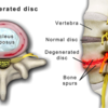 Surgical Treatment Options for Lumbar DDD: Minimally Invasive Discectomy, Laminectomy and Spinal Fusion Surgery