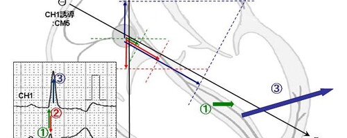 QRS波形をベクトルで読み解く　その4（左脚ブロック心電図）