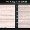 ECG-372：70才代男性。動悸と胸部不快感で歩行来院です 。=心電図検定試験 傾向と対策 Q.18 =