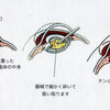 白内障の手術