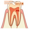 ⭐️虫歯の進行具合〜症状と治療まで〜⭐️