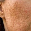 Advanced Acne and Acne Scar Treatments