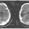 脳腫瘍・悪性リンパ腫治療記（29）治療終了の日