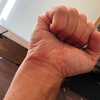 手首を痛めてラッキー！