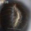 【口コミ】リアップリジェンヌ5年使ったビフォーアフターを写真で比較！