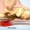 Understanding Heel Discomfort