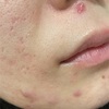 ニキビ発生😫