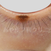まぶたのキワ部分のホクロ除去例