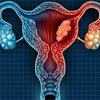 FIBROIDS EMBOLIZATION 