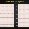 ECG-276：70才代男性。息切れです。