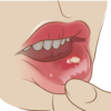 口内炎の原因