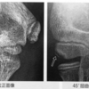 上腕骨小頭離断性骨軟骨炎の病因と病態　発生頻度・発生時期・発生部位・発生要因・炎症の関与・外力の関与・局所血流の関与