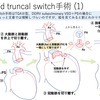 DORV(両大血管右室起始症)　その6　Posterior TGAやfalse Taussig-Bingについて(いわゆるsubpulmonary type DORV) その2　 Half-turned truncal switch手術について　　〜疾患42