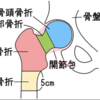 股関節骨折( 大腿骨転子部骨折）緊急入院！