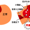 睡眠時無呼吸症候群の不眠にジアゼパム禁忌の理由