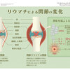 じじぃの「リウマチ治療薬・生物学的製剤とは！免疫が挑むがんと難病」