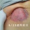 DFSP闘病生活回顧録（34）