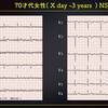 ECG-314：70才代女性。心房細動で、急性脳塞栓症でした。