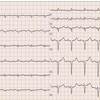 ECG-121：70才男性。徐々に下腿浮腫と呼吸苦が出現しました。