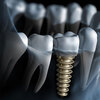 Europe Dental Implants Market Share, Trends, Scope, Industry Report and Future Growth by 2025