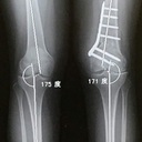 はと X脚 変形性膝関節症 骨切り記録