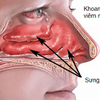 Phân biệt viêm mũi dị ứng khác gì so với viêm mũi thông thường