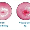 Viêm lộ tuyến cổ  tử cung độ 1 là bệnh gì?