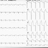 ECG-103：71才女性の心電図異常。AMIのはずですが。。