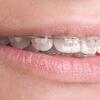 Điều trị niềng răng thẩm mỹ như thế nào ?