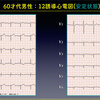 ECG-362：60才代男性の心電図です。症状なし。 = 心電図検定試験：傾向と対策 Q.010 =