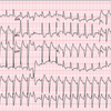 case144：術後に高血圧と頻脈を呈し急変した61歳男性（N Engl J Med. 2021 Jun 3;384(22):2145-2152.）