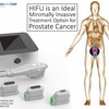 HIFU is an Ideal Minimally Invasive Treatment for Prostate Cancer