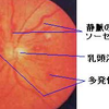 ソーセージ様怒張の原因と機序