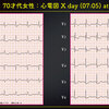 ECG-336：70才代女性です。胸のモヤモヤが続き、受診となりました。