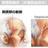 側頭動脈炎について