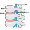 ヘルニアに関する雑学