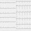 ECG-129：76才男性。Afibです。