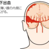 くも膜下出血で警告頭痛が起こる理由