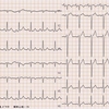 ECG-225 : 60才代の(どうしようもない)呼吸苦で、ER受診となった患者さんです。