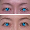 極小切開からの眼瞼下垂手術　　二重ライン幅を狭くする。