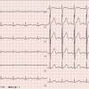 ECG-166：answer