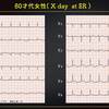 ECG-290：80才代の女性。夜間突然のchest discomfort/dyspneaです。