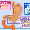 胃を切ることの影響