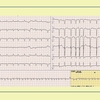 ECG-395：answer