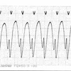 ECG-102：answer