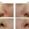 切らない鼻翼縮小術で小鼻を小さくします。